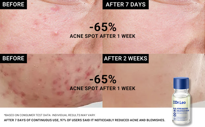 1.8% Salicylic Acid Drying Lotion (2 pcs）