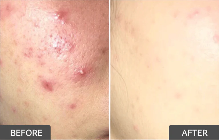 1.8% Salicylic Acid Drying Lotion (2 pcs）