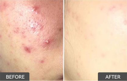 1.8% Salicylic Acid Drying Lotion (2 pcs）